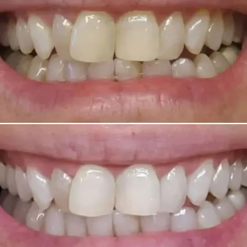 Before and after Whitening Strips